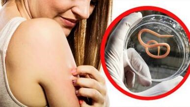 Unha erupción no corpo é un sinal dunha infección por helmintos